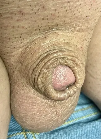 inverted tiny penis         