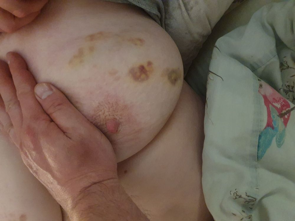 Mrs. Kink&#039;s Bruised Tits #6