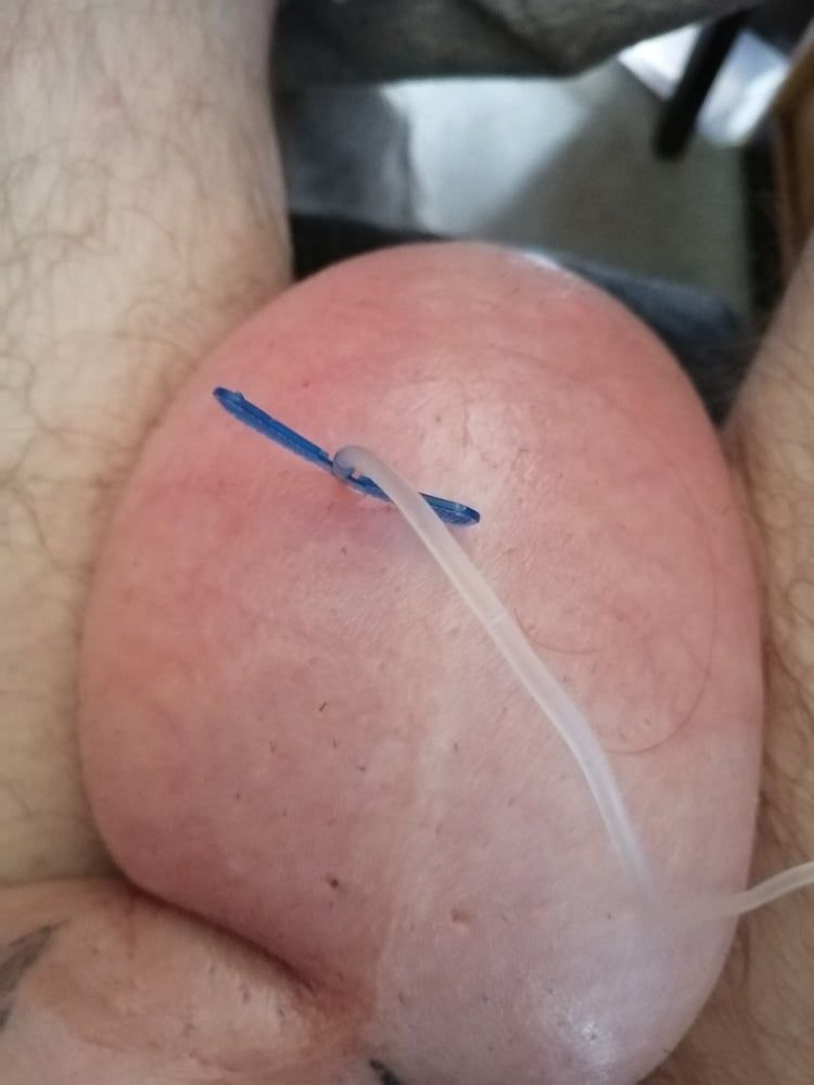 saline infusion scrotum - more as 2 l #15