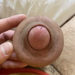 Extreme stretching foreskin