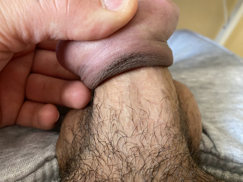 Foreskin extreme stretching porn #5