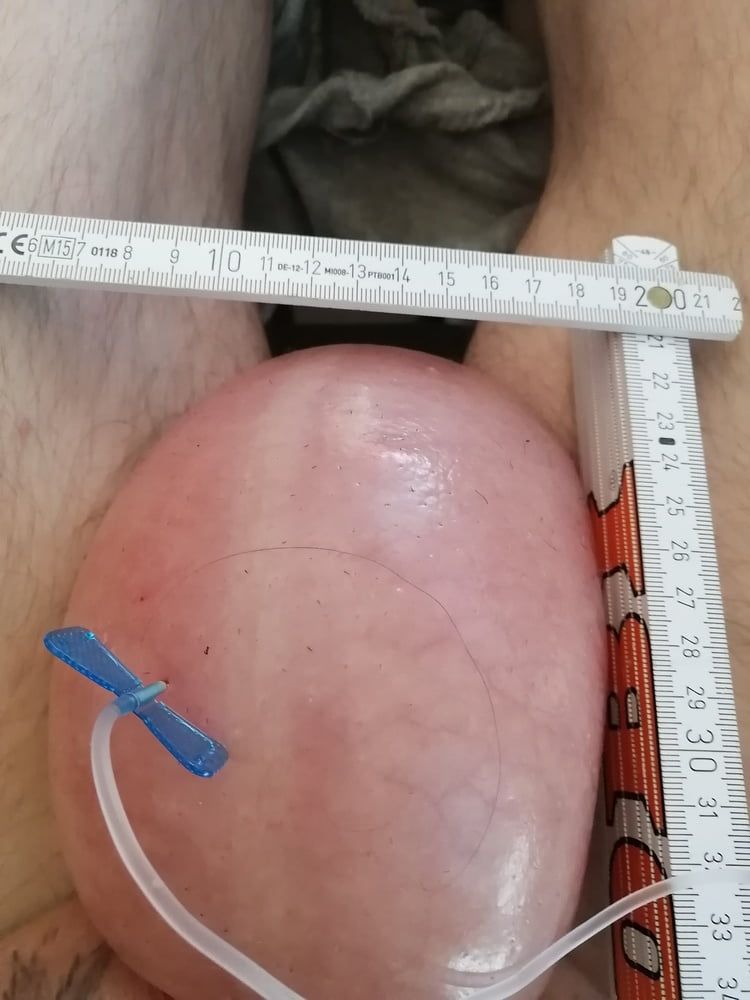 saline infusion scrotum - more as 2 l #17