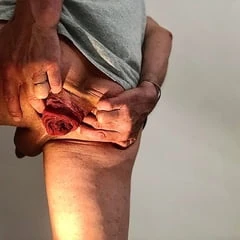 oops my rectum came out - anal prolapse