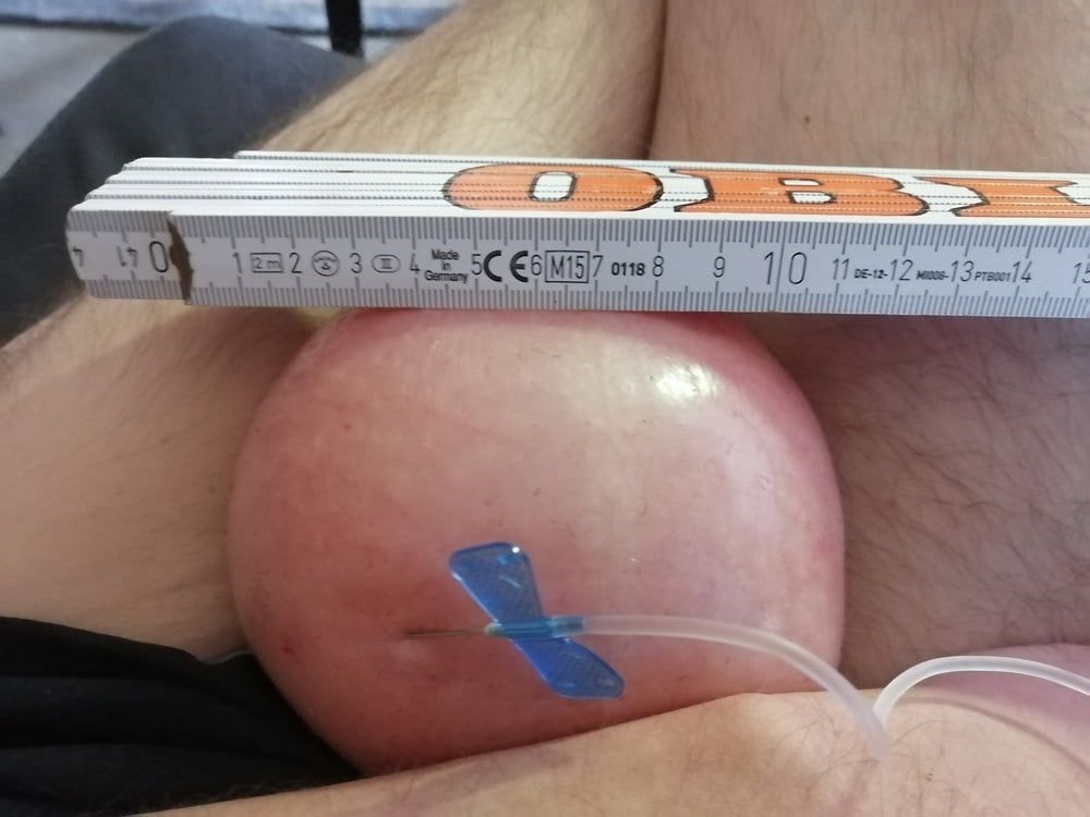 saline-infusion in scrotum first try 1 liter #13