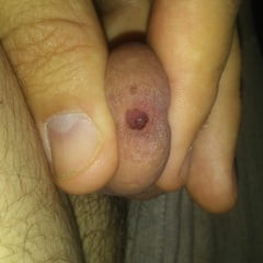 My secret freckle