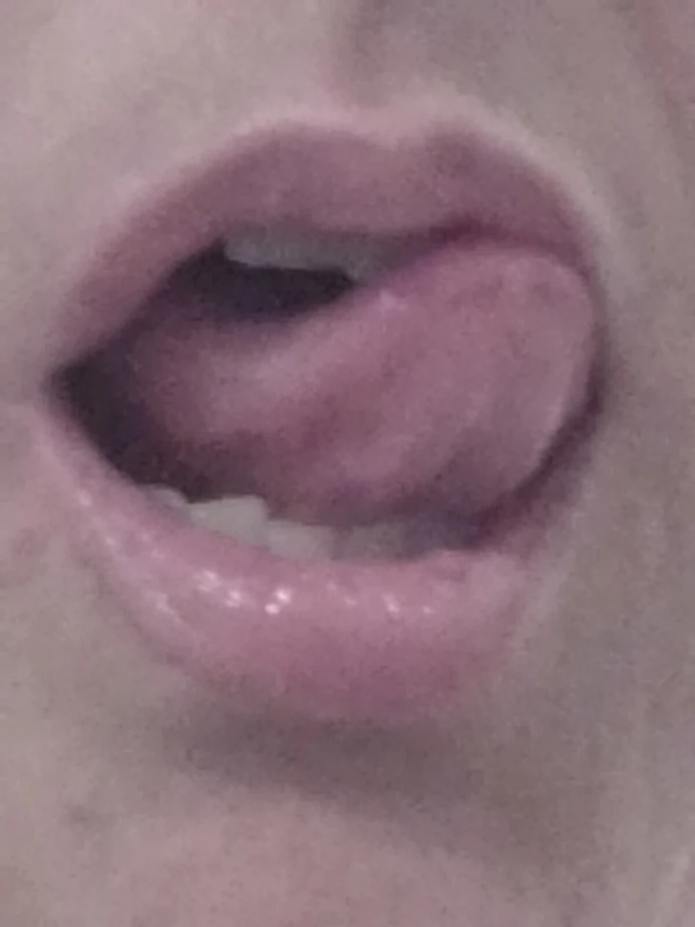 Teaser