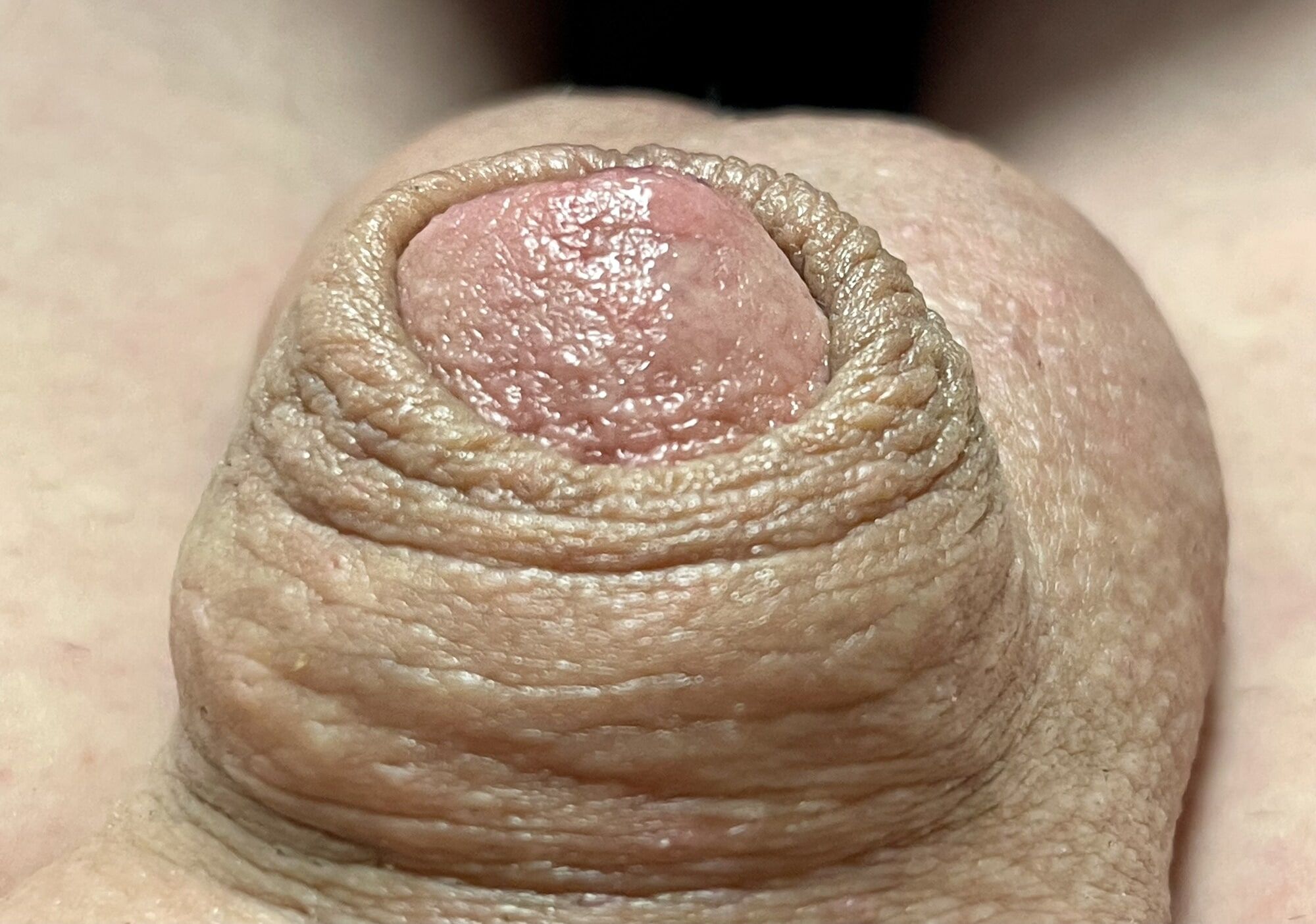 Micropenis close up