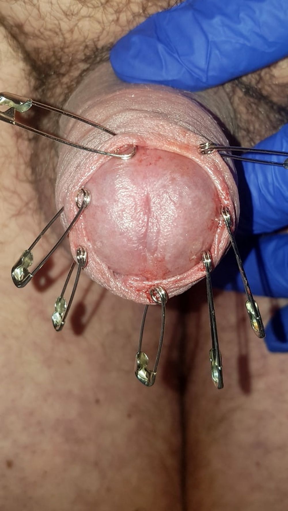 CBT Needles #33