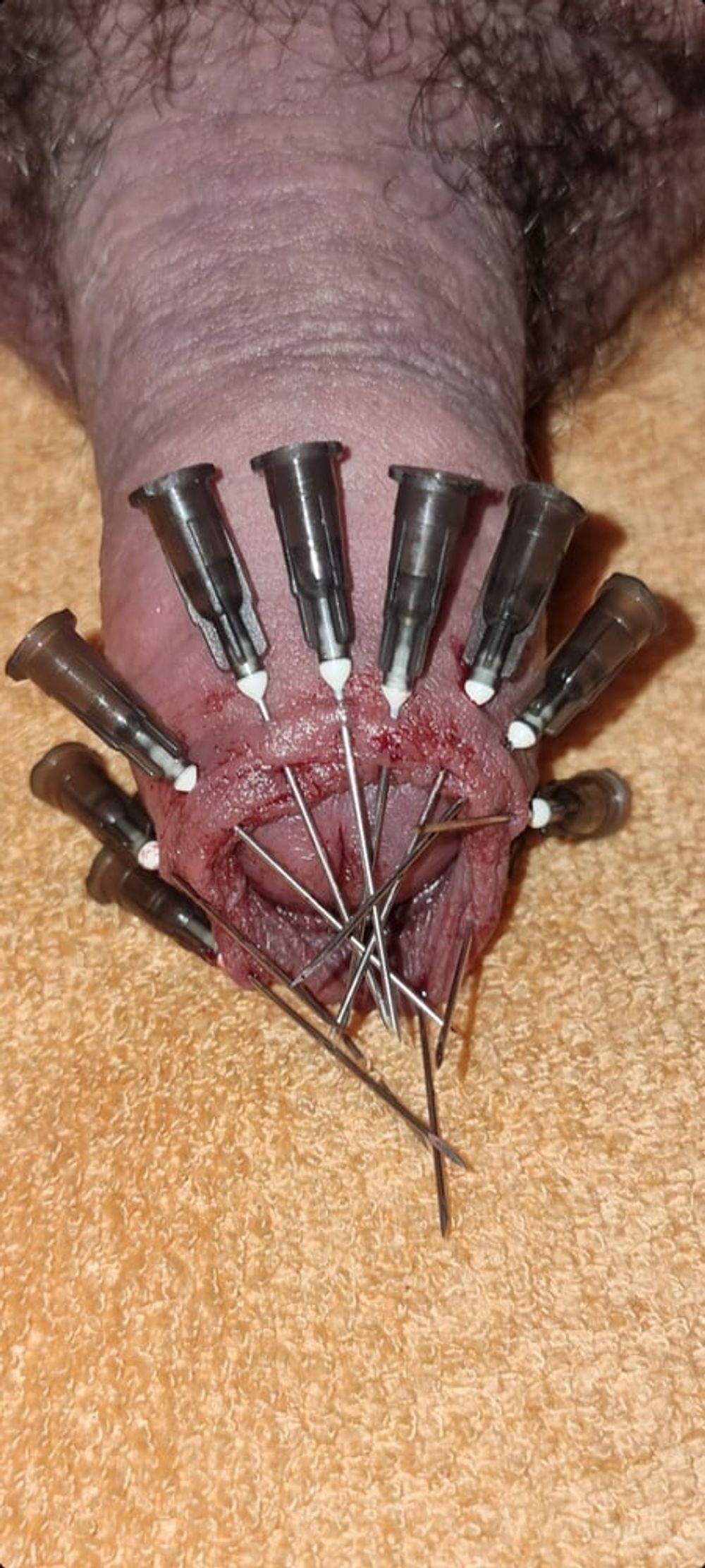 CBT Needles #7