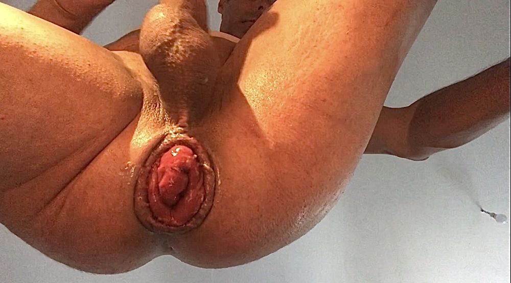 wow nice progress anal prolapse #25