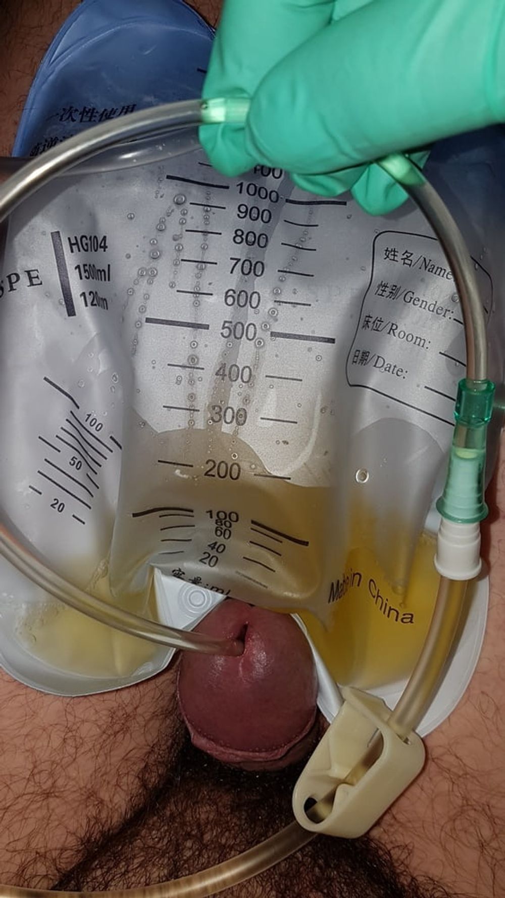 Catheter sounding with my urine 2 #16