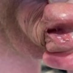 Glans Hypospadias 