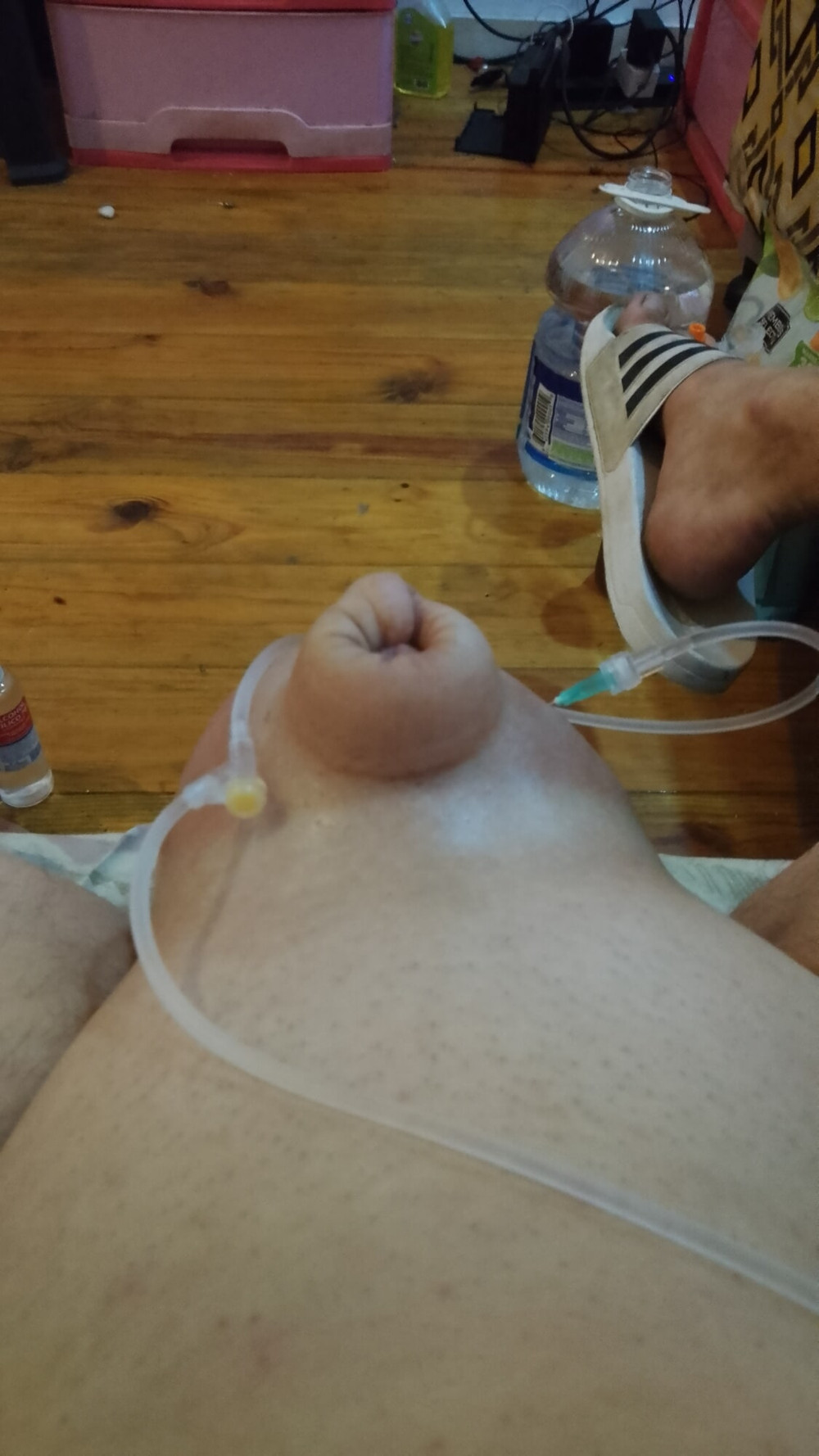 2L D5NS infusion transforming my sac into a beach ball #29