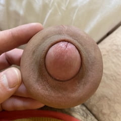 Extreme stretching foreskin