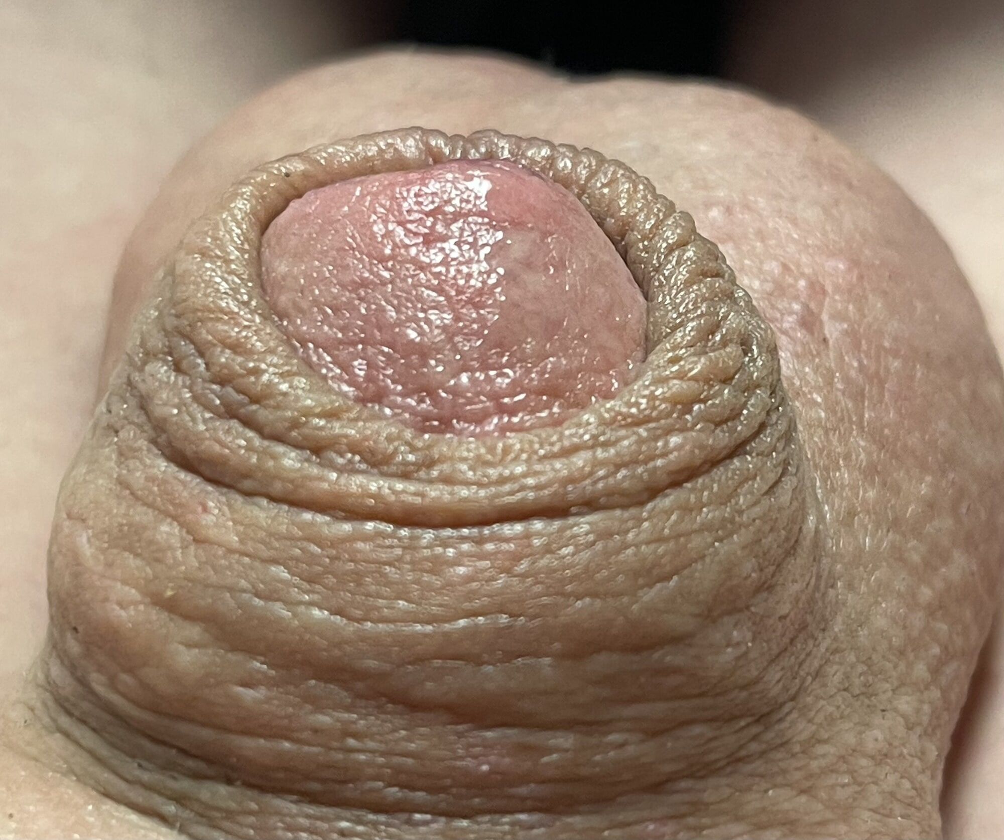 Micropenis close up #2