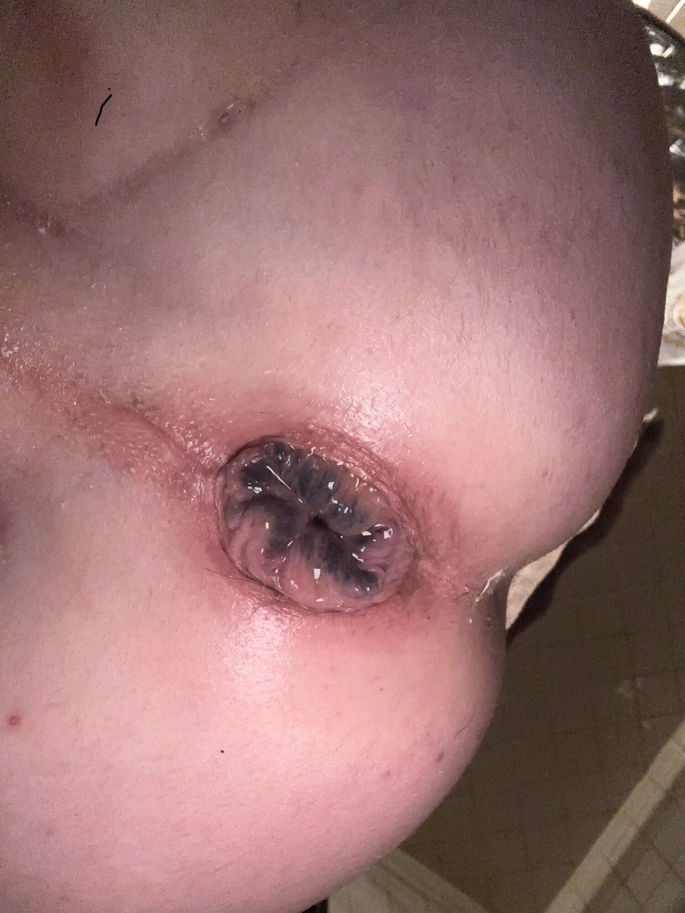 My used gaping black and blue hole! #3