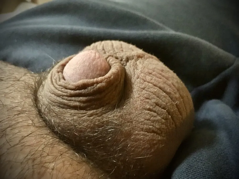 Tiny Dick, Micropenis 