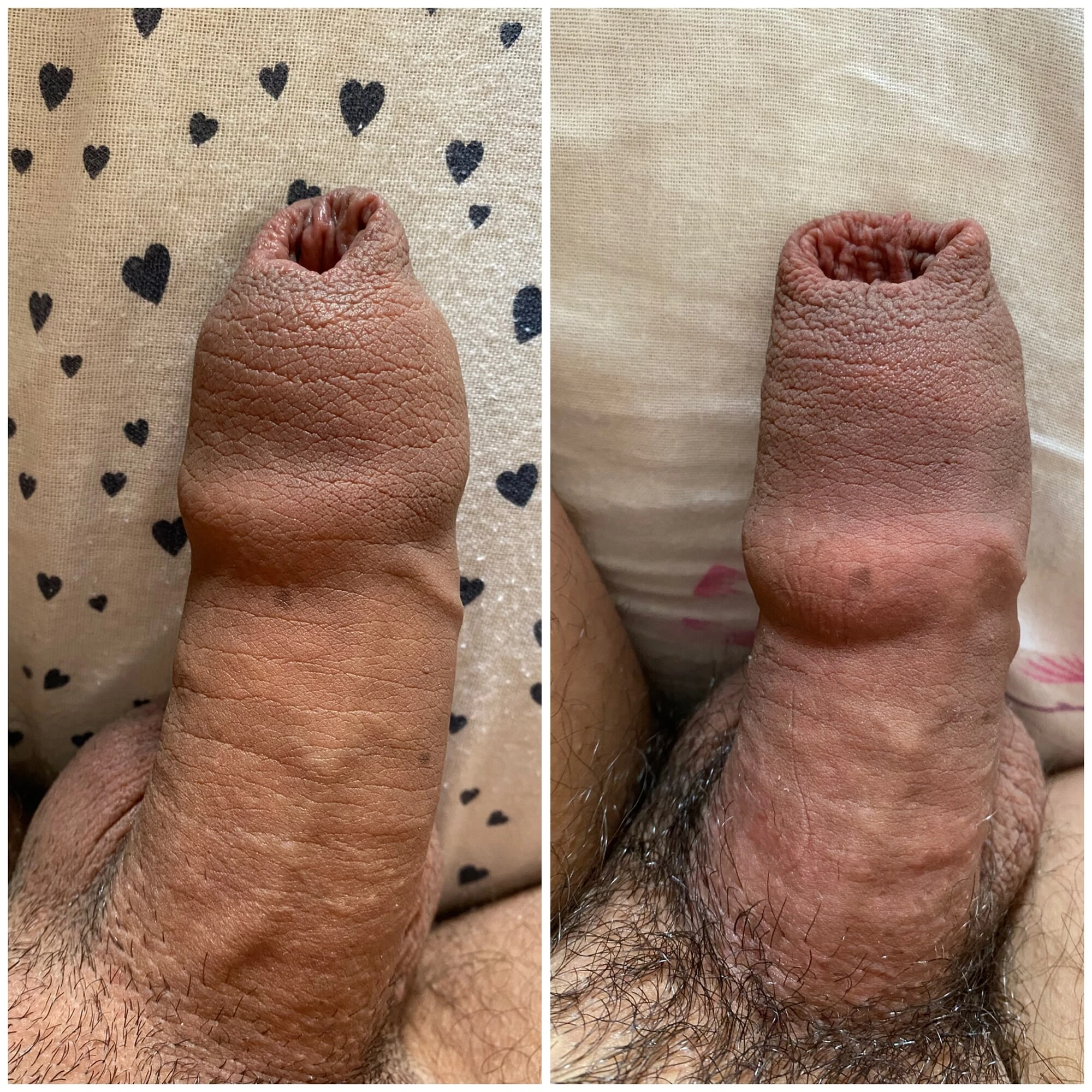 foreskin before and after
