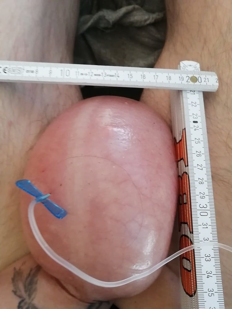 saline infusion scrotum - more as 2 l #19