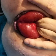 extreme prolapse pumping