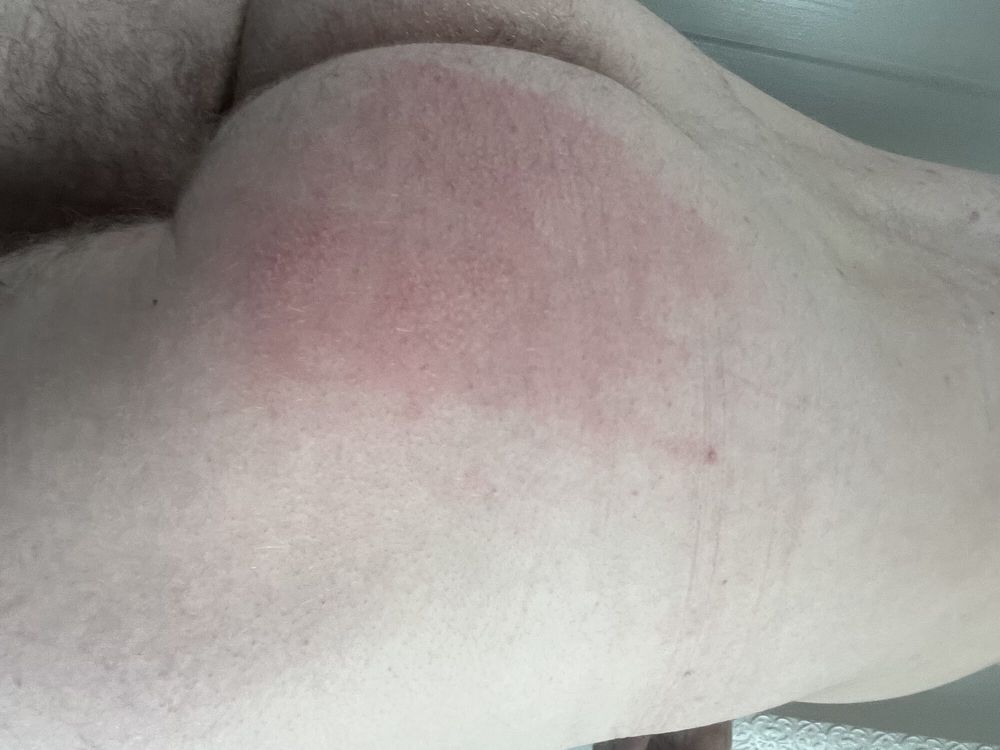 Bruised cock #3