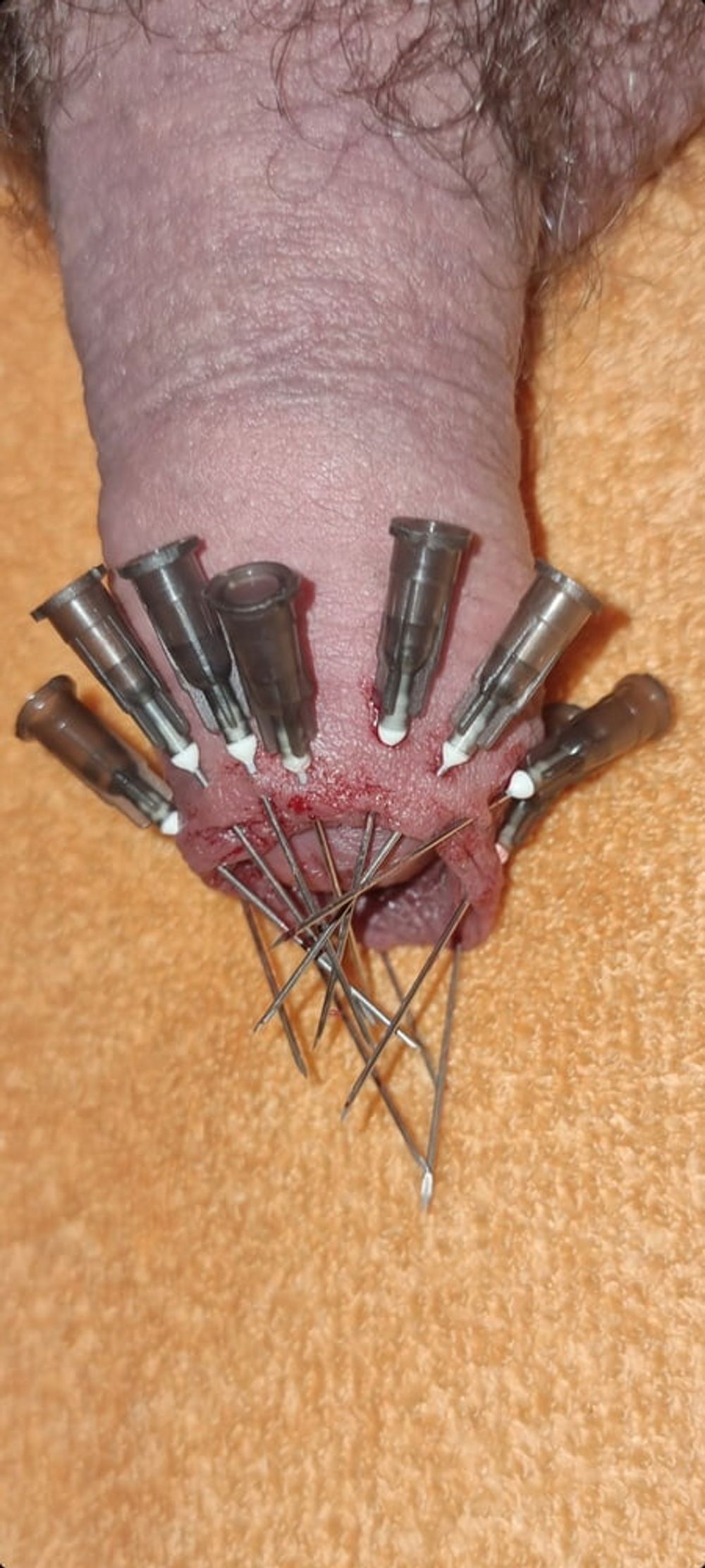 CBT Needles #5