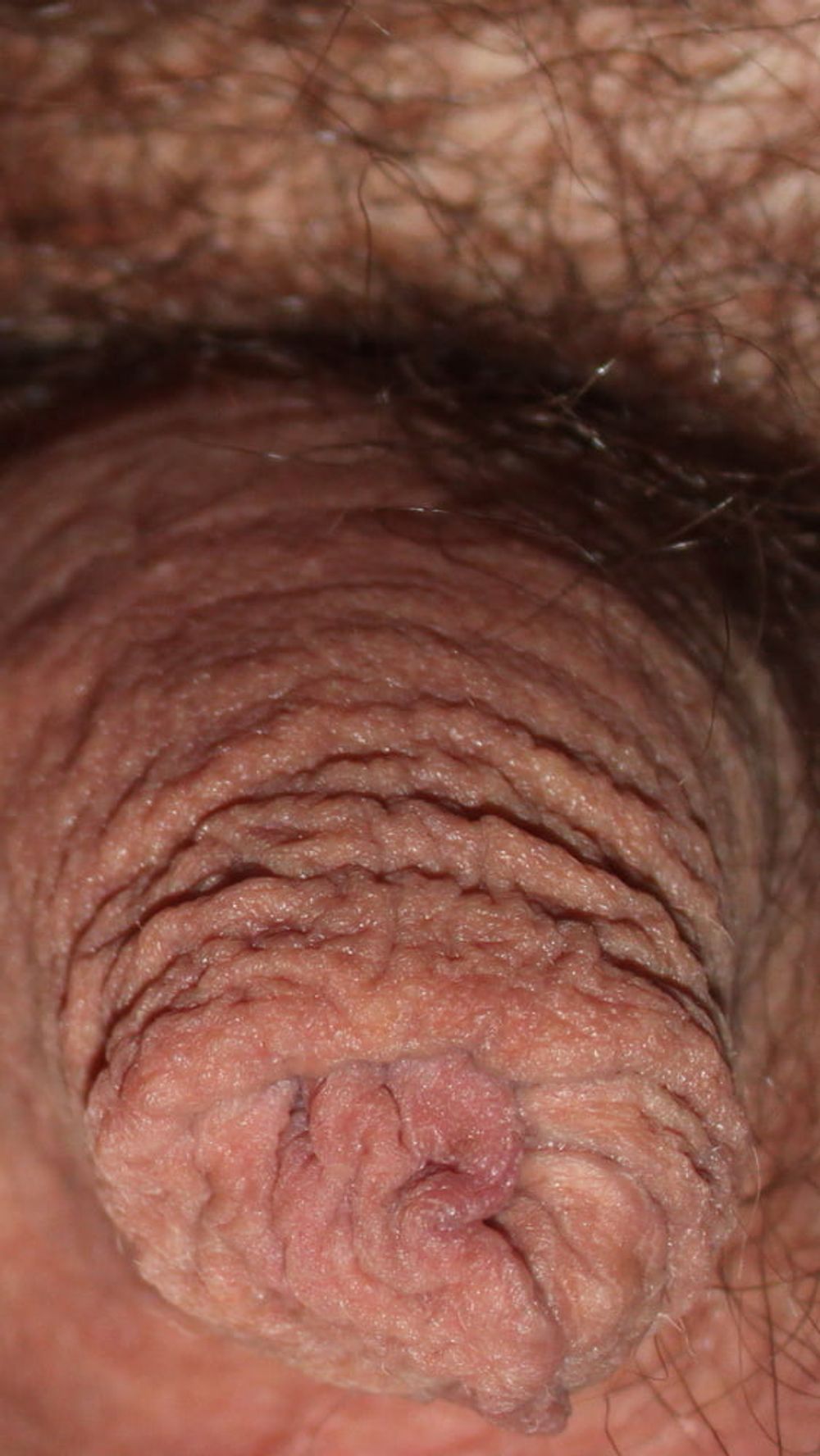 My foreskin #49