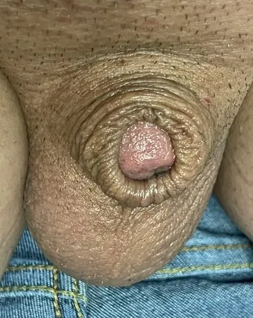 inverted tiny penis         