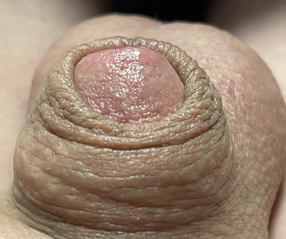 Micropenis close up #3