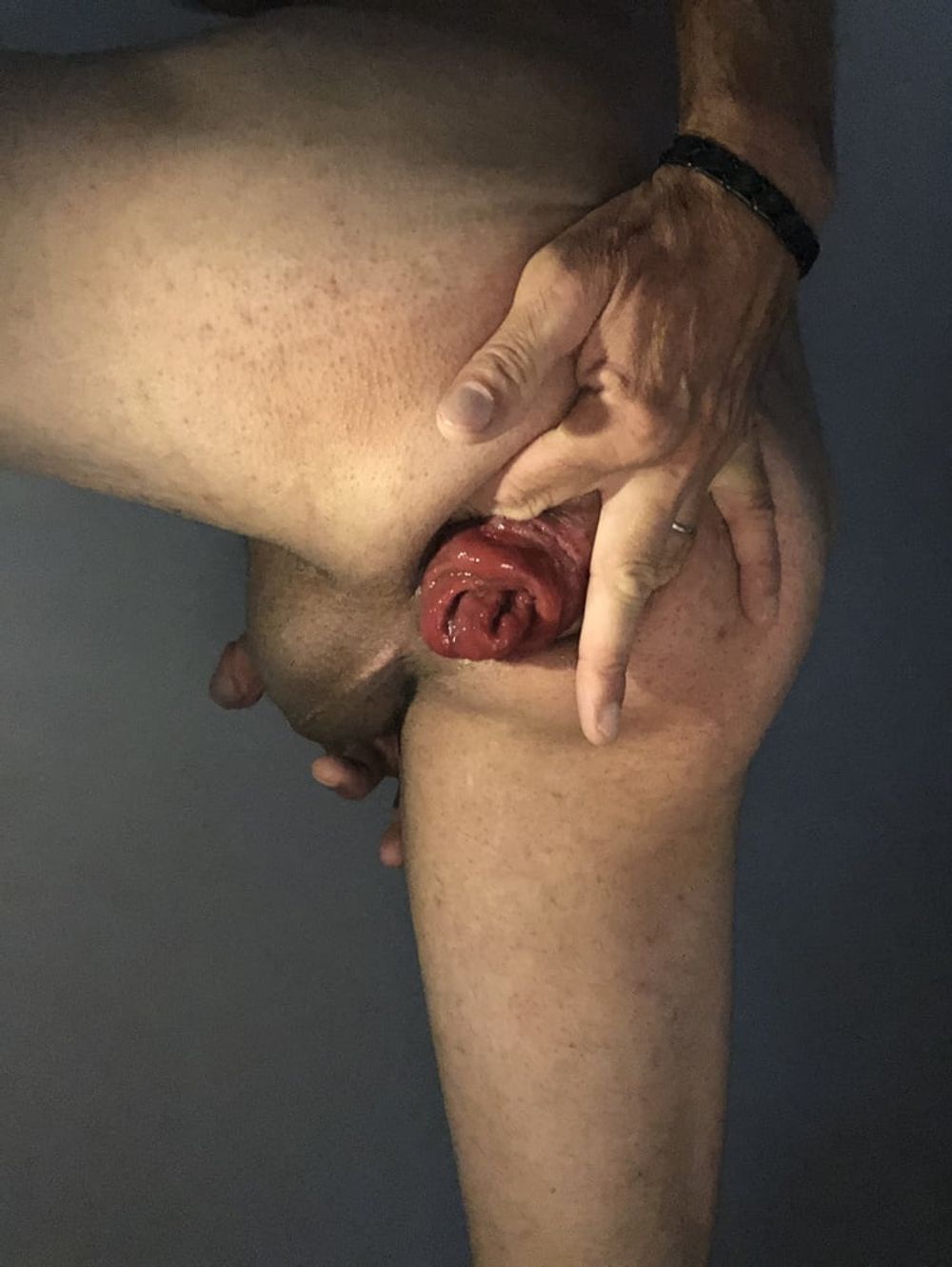 my anal prolapse is changing incredibly #6