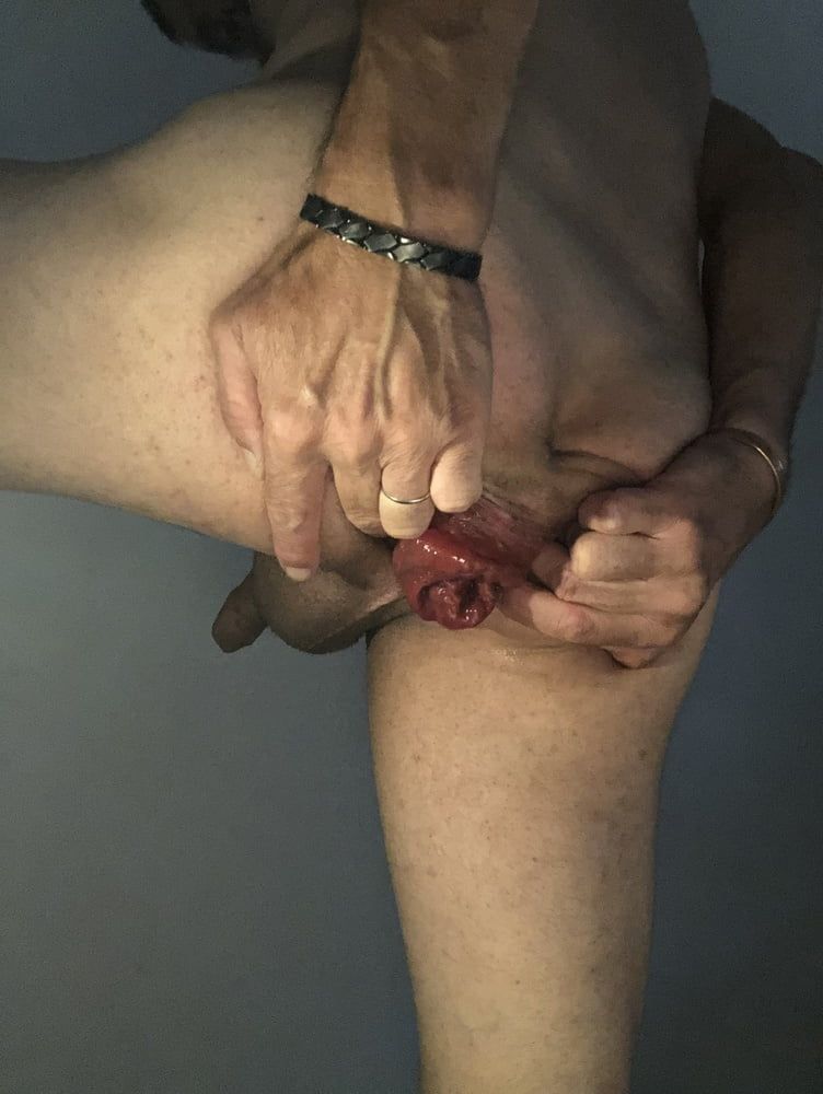 my anal prolapse is changing incredibly #3
