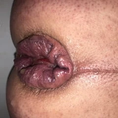 My prolapsing anus