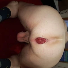 Asshole prolapse