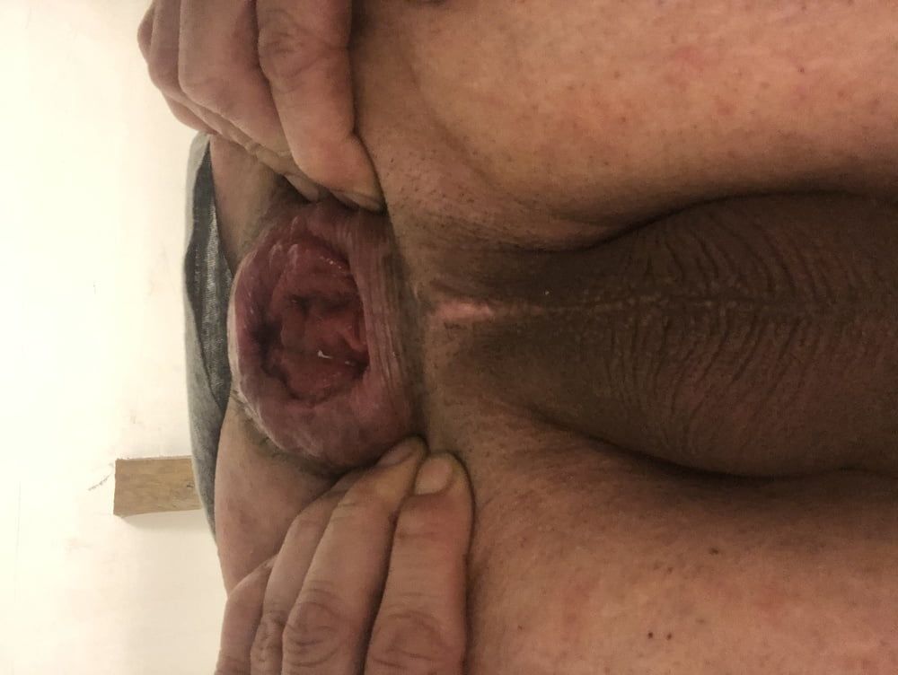 anal dilation after big insertion #17