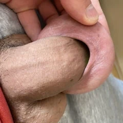 Foreskin extreme stretching porn