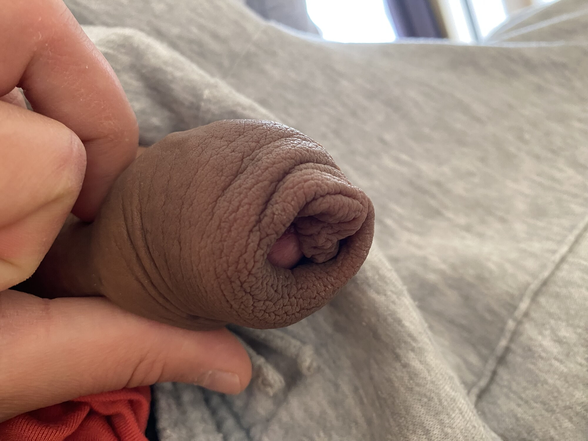 Very loose foreskin