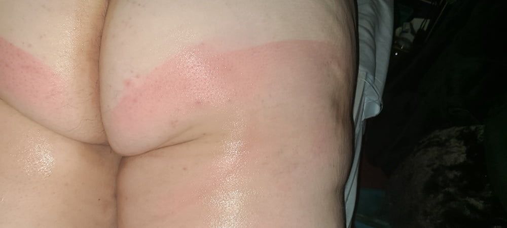 Sun burn #13