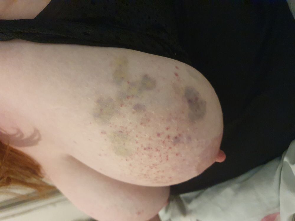 Mrs. Kink&#039;s Bruised Tits #3