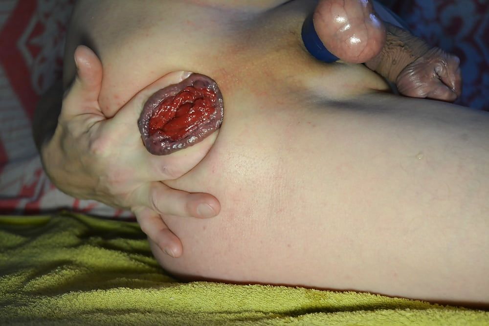 extreme prolapse pumping