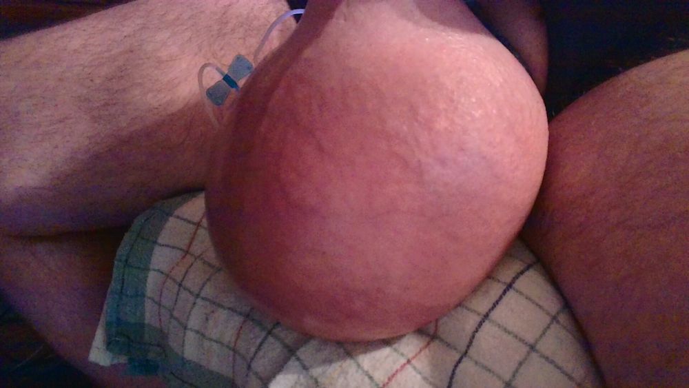 Saline Balls #56