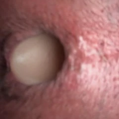 Anal gaping 