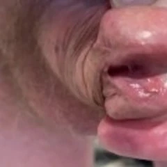 Glans Hypospadias 