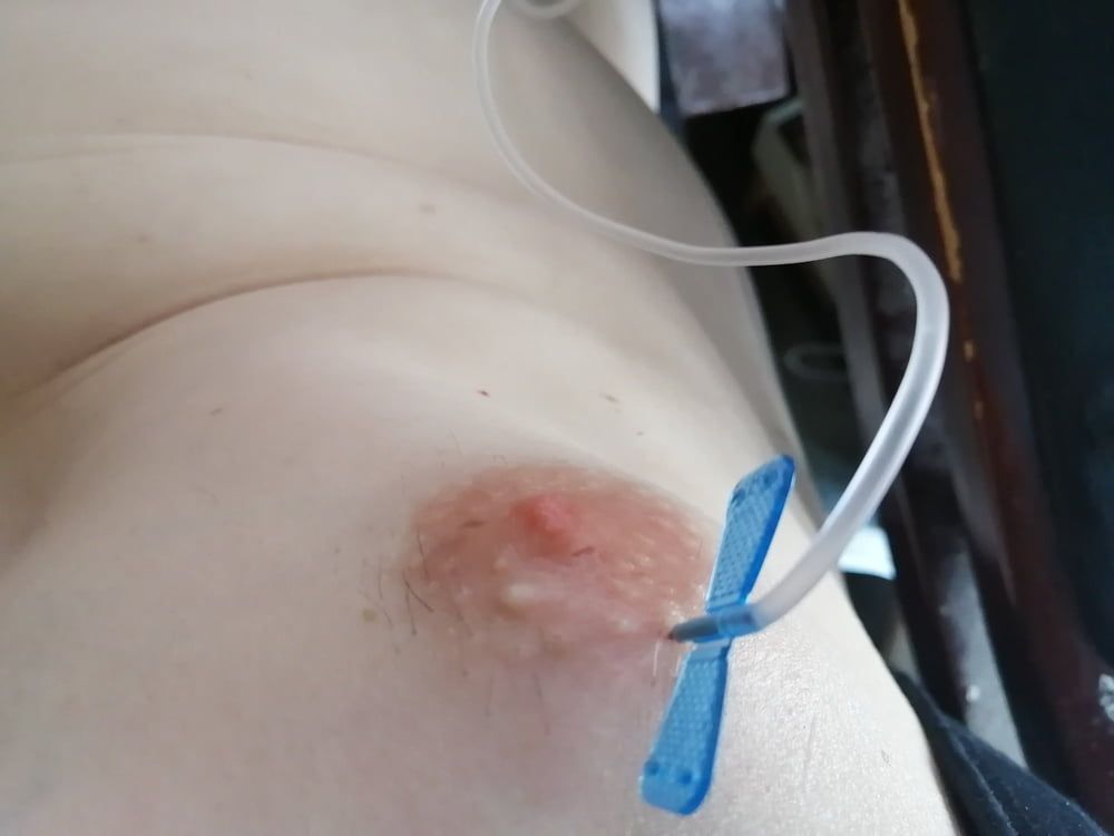 saline infusion scrotum - more as 2 l #25