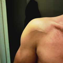 My biceps vein