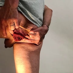 oops my rectum came out - anal prolapse