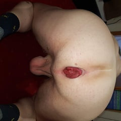 Asshole prolapse