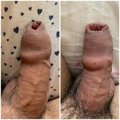 包皮の前後