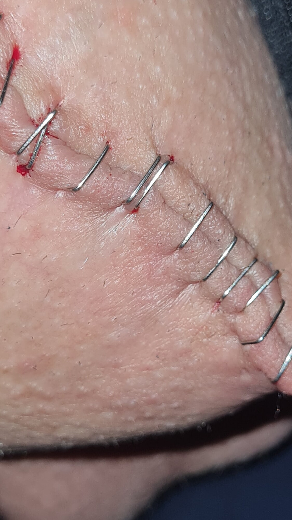 Stapled cock and balls #10
