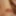 Tiny Cock Micropenis Small Dick
