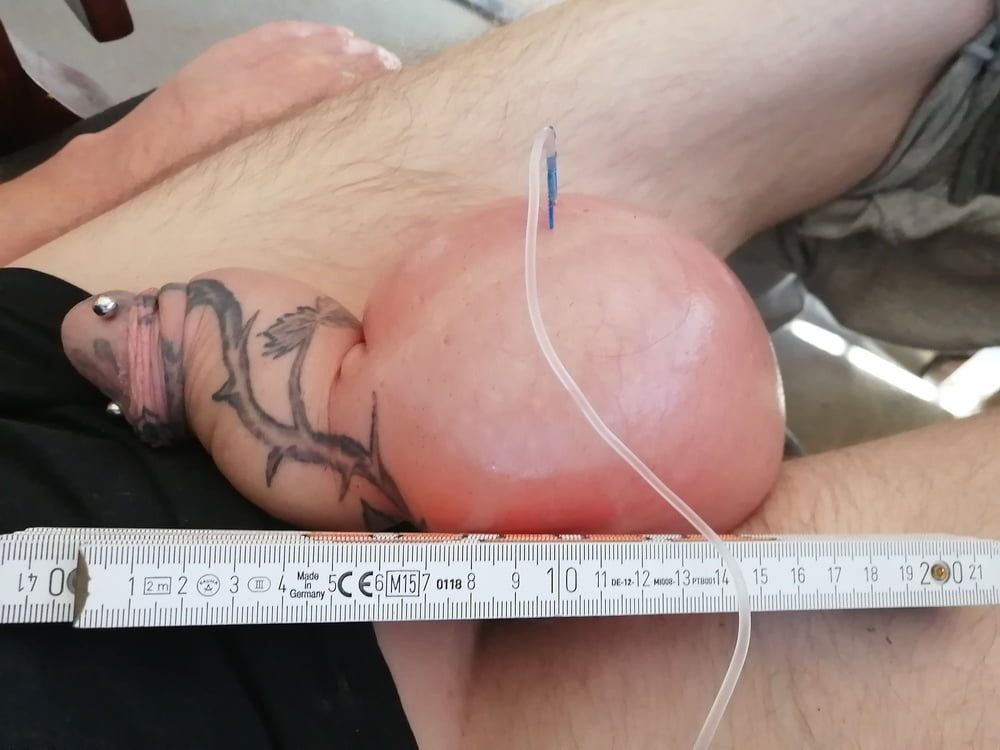 saline infusion scrotum - more as 2 l #20
